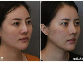 北京鼻子整形,专业医院与医生推荐，塑造自然美鼻之旅